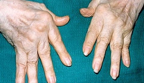 Schmerzen in den Fingergelenken