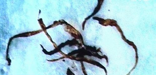 Morgellons-Krankheit existiert tatsächlich und könnte mit GVO in Verbindung gebracht werden