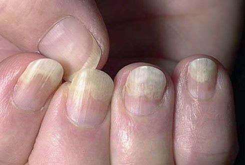 Trennung der Nagelplatte vom Weichgewebe