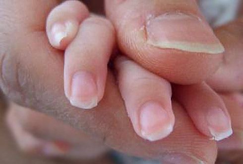 Nägel schälen sich, auf der Oberfläche sind vertikale Streifen erschienen