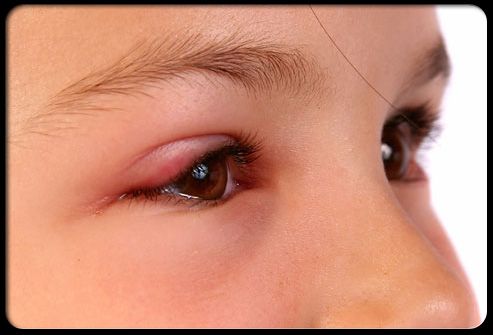 Rote geschwollene Augenlider