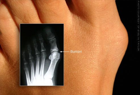 Bunion vulgus-Deformität der großen Zehe