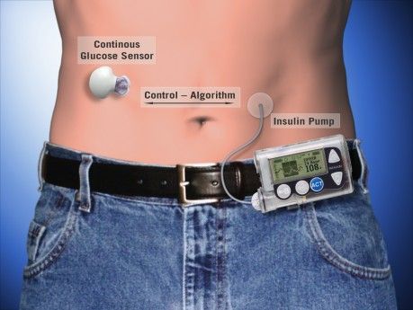 Diabetes künstliche Bauchspeicheldrüse