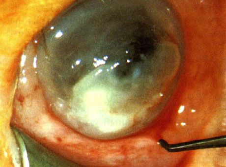 Keratitis, verursacht durch Pseudomonas bei einem Neugeborenen.  Prädisponierende Faktoren werden nicht identifiziert