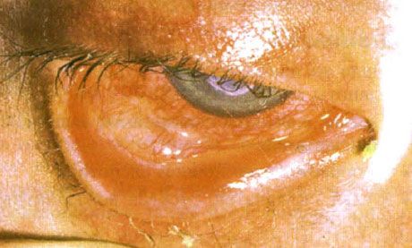 Syndrom Stevens-Johnson.  Zweiseitige desquamative Konjunktivitis mit Nekrosen.  Schwere Keratitis, die das Auftreten von Narben auf der Hornhaut verursacht.  Die Situation wurde durch das Hinzufügen des Syndroms der "trockenen" Augen kompliziert