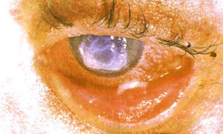 Syndrom Stevens-Johnson.  Zweiseitige desquamative Konjunktivitis mit Nekrosen.  Schwere Keratitis, die das Auftreten von Narben auf der Hornhaut verursacht.  Die Situation wurde durch das Hinzufügen des Syndroms der "trockenen" Augen kompliziert