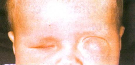 Mikrophthalmus mit assoziierter Zystenbildung (linkes Auge). Anophthalmus (rechtes Auge).
