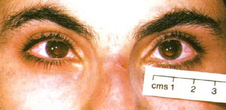 Nanoftaplm. Die Augen werden verkleinert.