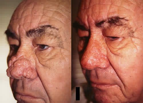 Rhinophym