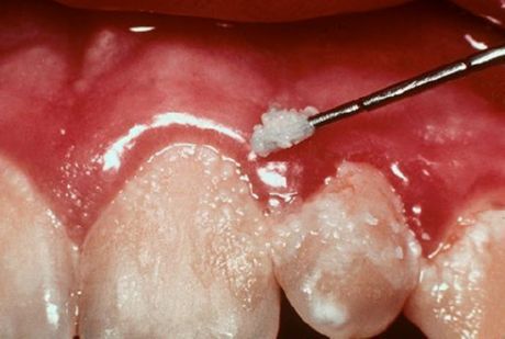Zähne und Zahnfleischentzündung