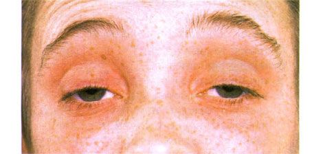 Externe Ophthalmoplegie.  Zweiseitige Ptosis.  Der Patient öffnet die Augen, indem er die Augenbrauen hebt