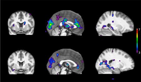 Scans zeigen Bereiche der Gehirnaktivität als Reaktion auf Reize bei Menschen, die Nikotin schnell (obere Reihe) und langsam (untere Reihe) metabolisieren.