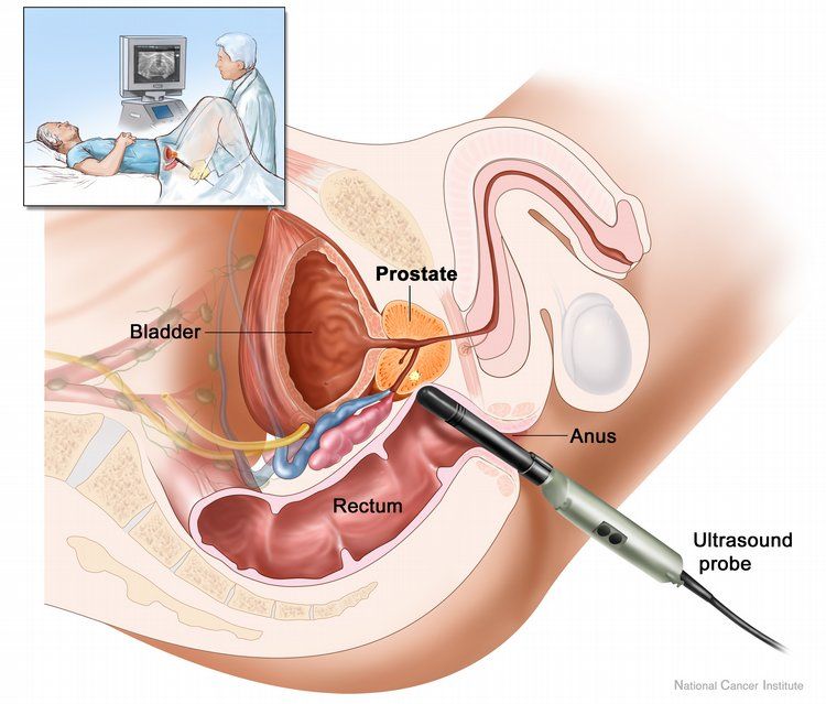 Auf Basis von Tee und Gold wurde ein wirksames Medikament gegen Prostatakrebs entwickelt