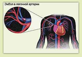 Lungenembolie und Brustschmerzen links
