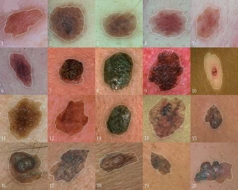 Wissenschaftler haben ein Gen entdeckt, das eine zentrale Rolle bei der Entstehung von Melanomen spielt
