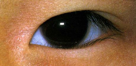 Abnormes Wimpernwachstum ist von Geburt an vorhanden. Manchmal kommt es zu einer spontanen Besserung.