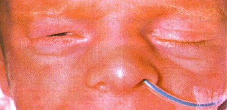 Angeborenes Entropium (Inversion).